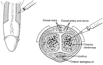 Trimix injection Step 7: Select lateral shaft injection site for penile injection — Dr. Kashani erectile dysfunction urologist Long Island
