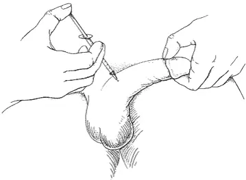 Trimix penile injection Step 8: Insert needle at 90-degree angle and inject medication slowly — erectile dysfunction ICI treatment