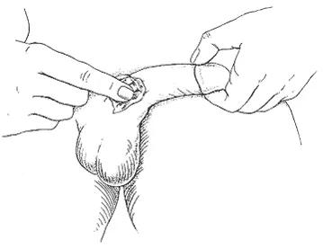 Trimix injection Step 9: Apply firm pressure after needle removal to prevent bruising — post-injection care erectile dysfunction